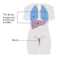 Stage 4 choriocarcinoma