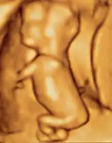 3D ultrasound of 3-inch (76&nbsp;mm) fetus (about 14 weeks gestational age)
